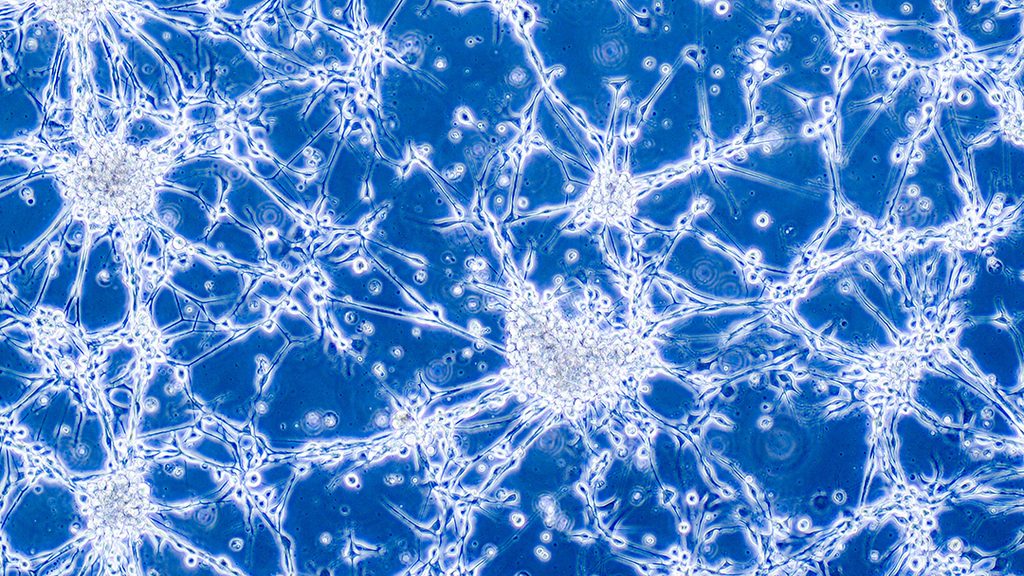 Glioblastoma brain cancer cells - Vended Stock - Shutterstock; Glioblastoma brain cancer cells under a microscope